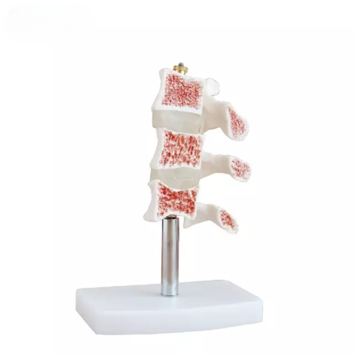 [b2-01-29-533] Modelo de osteoporosis seccionado